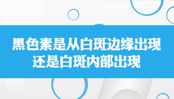 `308激光照射治疗白癜风白斑复发问题探析`