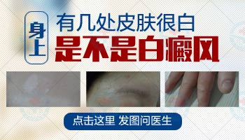 白斑普通医院能治疗吗？专业解析与治疗途径