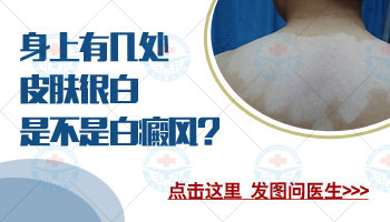 311灯照白癜风治疗：辐射安全性与效果深度解析