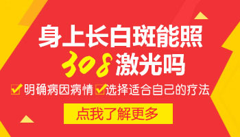 308激光治疗白斑价格及治疗详解