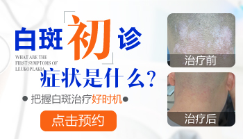 308准分子激光治疗白斑：多久可见效果？