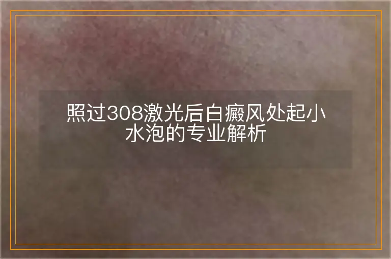 照过308激光后白癜风处起小水泡的专业解析