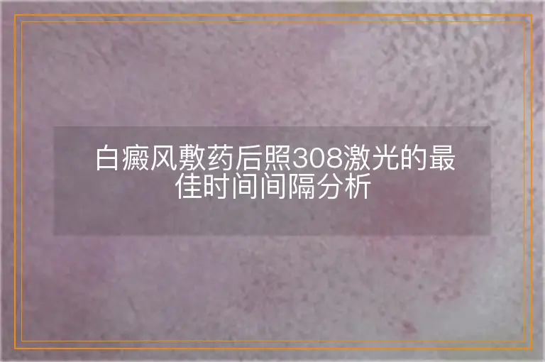 白癜风敷药后照308激光的最佳时间间隔分析