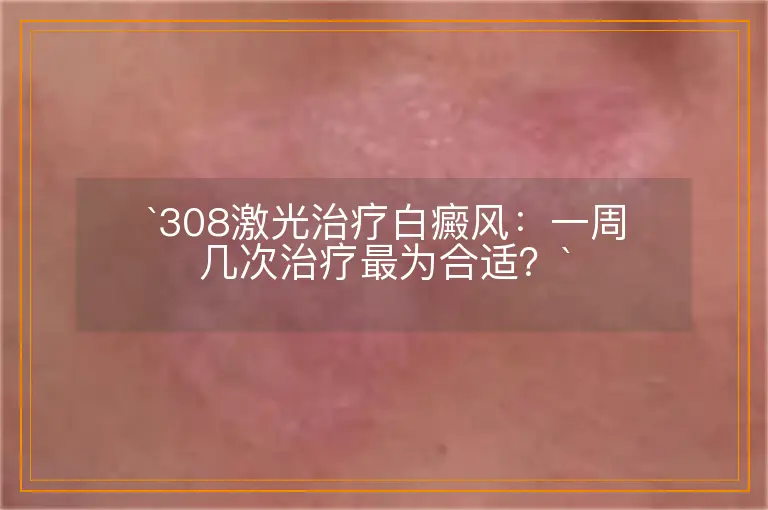 `308激光治疗白癜风：一周几次治疗最为合适？`