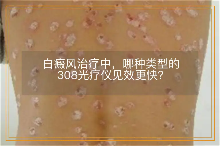 白癜风治疗中，哪种类型的308光疗仪见效更快？