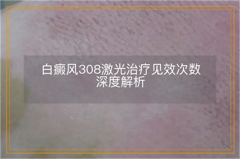 白癜风308激光治疗见效次数深度解析