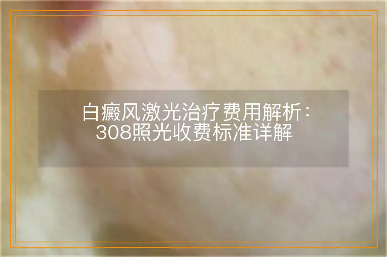 白癜风激光治疗费用解析：308照光收费标准详解