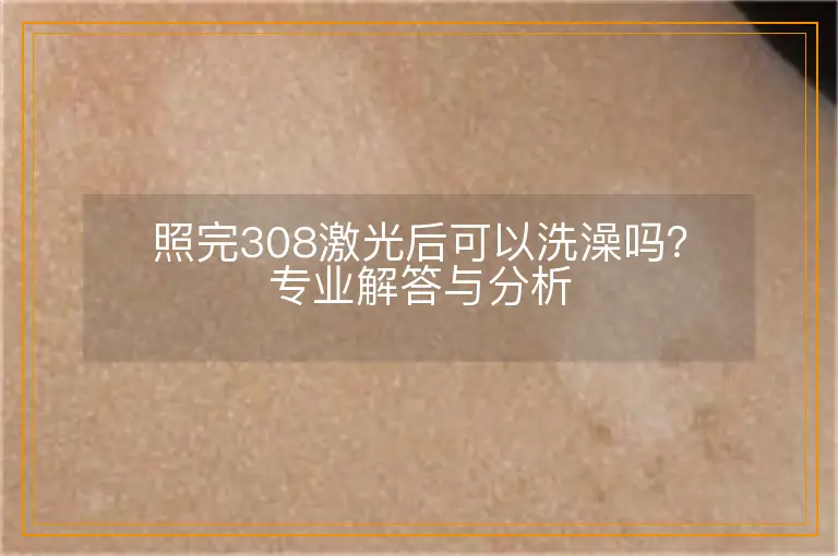 照完308激光后可以洗澡吗？专业解答与分析