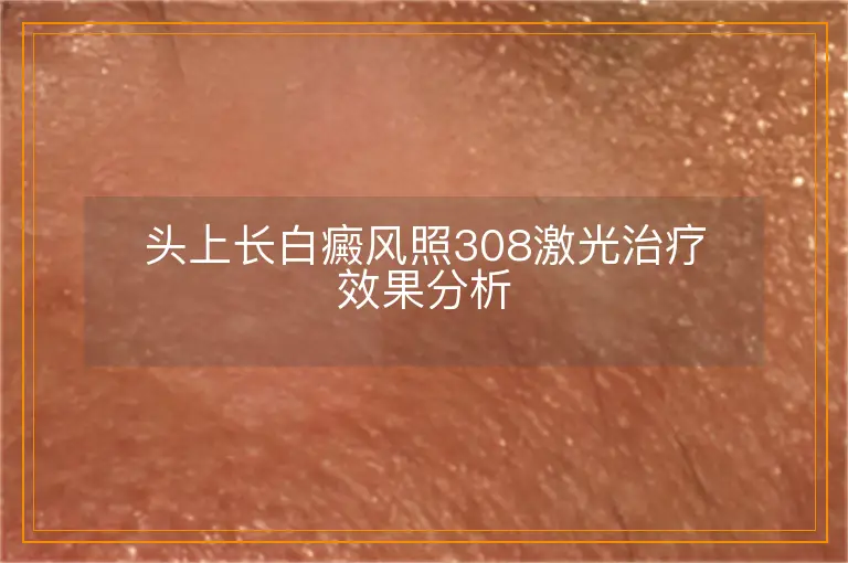 头上长白癜风照308激光治疗效果分析