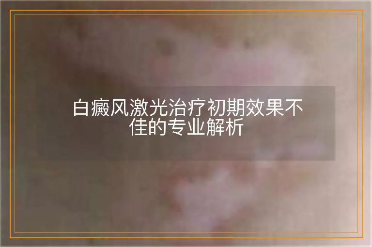 白癜风激光治疗初期效果不佳的专业解析