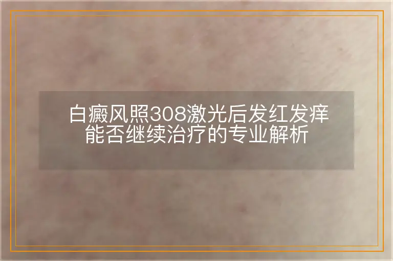 白癜风照308激光后发红发痒能否继续治疗的专业解析