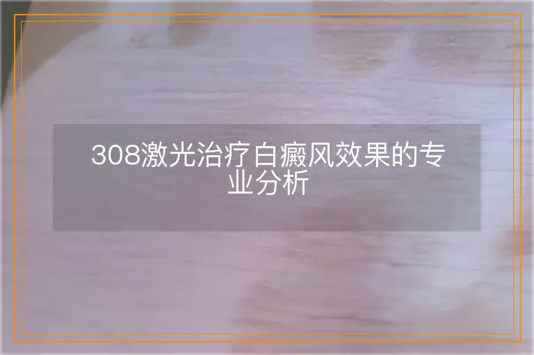 308激光治疗白癜风效果的专业分析