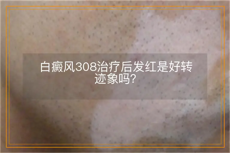 白癜风308治疗后发红是好转迹象吗？