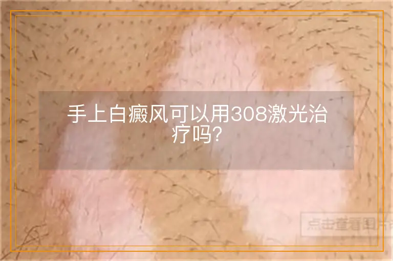 手上白癜风可以用308激光治疗吗？