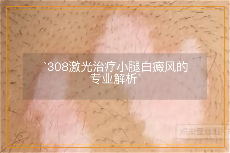 `308激光治疗小腿白癜风的专业解析`