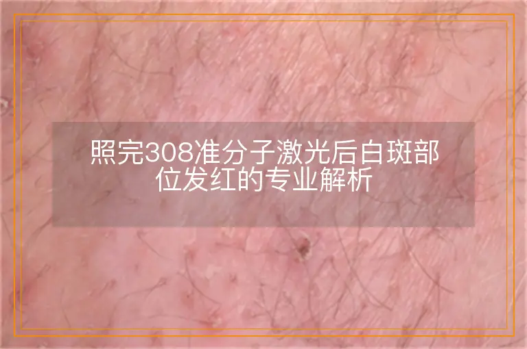 照完308准分子激光后白斑部位发红的专业解析