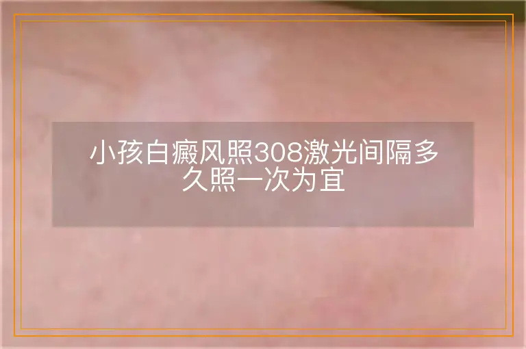 小孩白癜风照308激光间隔多久照一次为宜