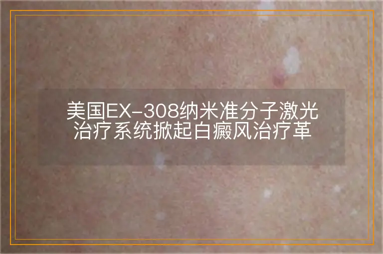 美国EX-308纳米准分子激光治疗系统掀起白癜风治疗革命狂潮