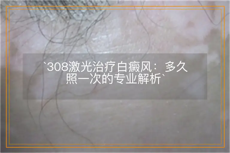 `308激光治疗白癜风：多久照一次的专业解析`