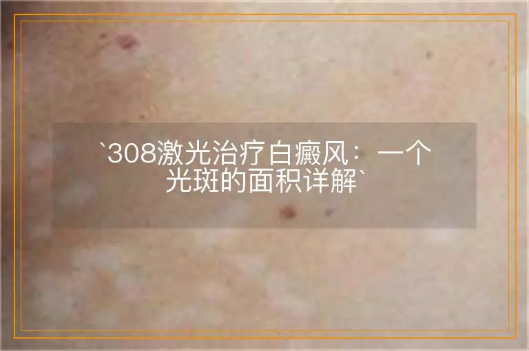 `308激光治疗白癜风：一个光斑的面积详解`