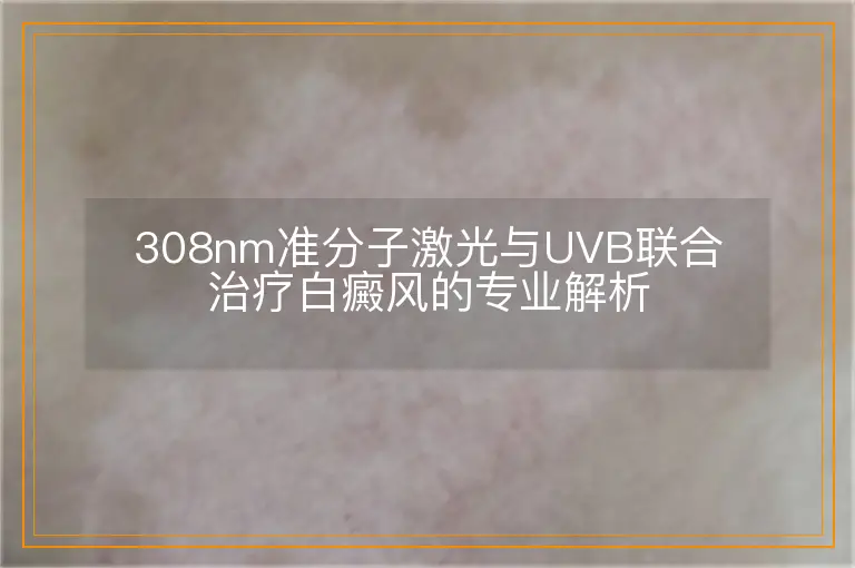 308nm准分子激光与UVB联合治疗白癜风的专业解析