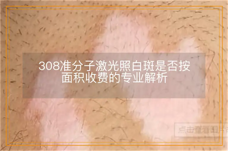 308准分子激光照白斑是否按面积收费的专业解析