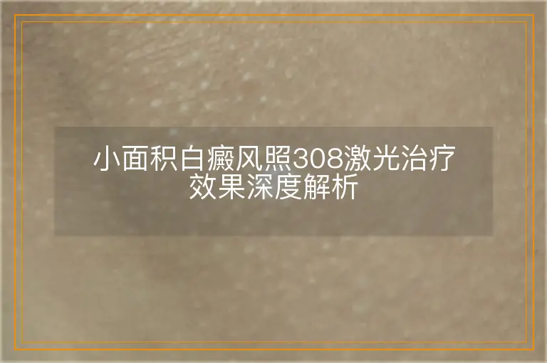 小面积白癜风照308激光治疗效果深度解析