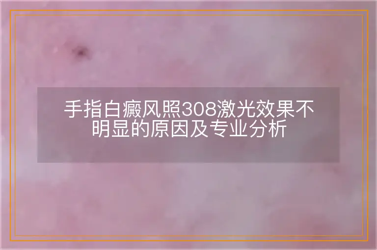 手指白癜风照308激光效果不明显的原因及专业分析