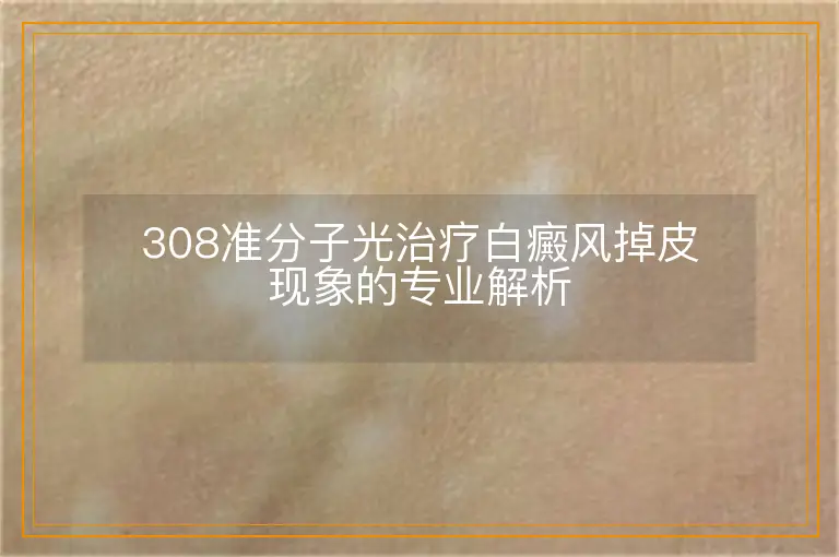 308准分子光治疗白癜风掉皮现象的专业解析